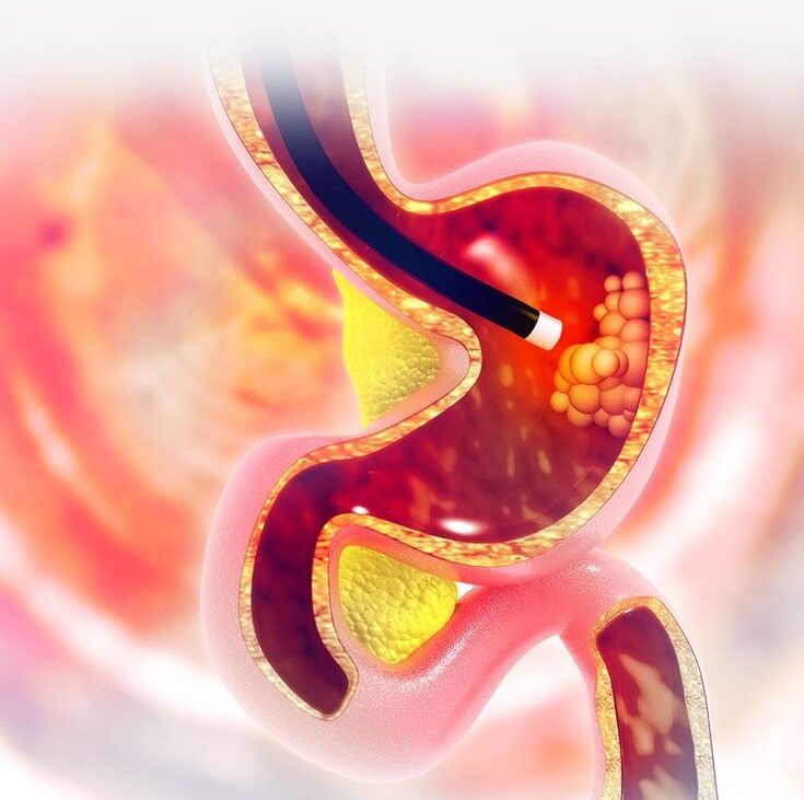 Medical illustration showing an endoscopy procedure examining the inside of the stomach.