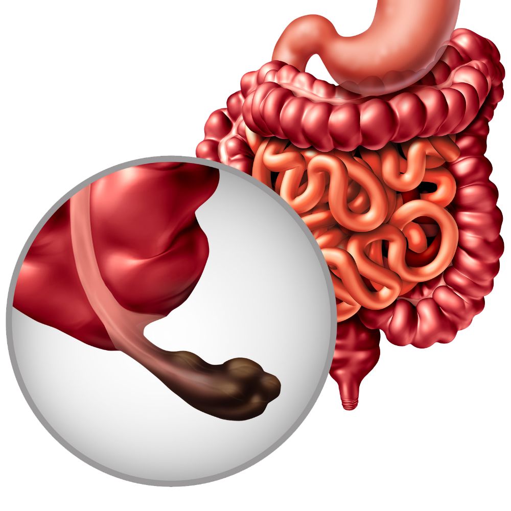 Illustration showing inflamed appendix in the human digestive system.
