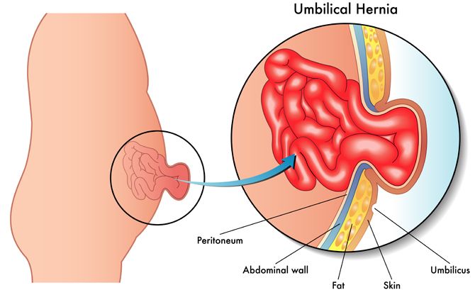 Medical diagram showing an umbilical hernia with labeled abdominal wall, fat, and peritoneum.