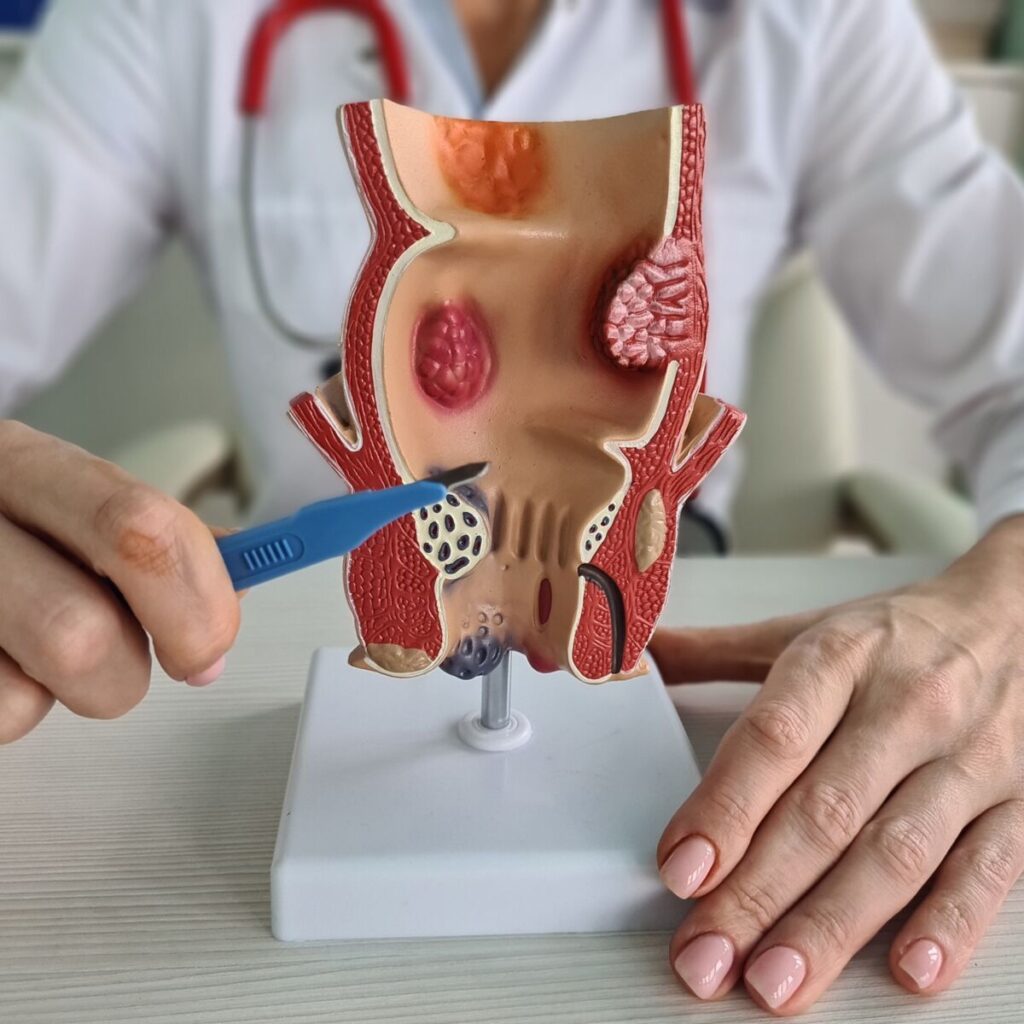 Doctor pointing to hemorrhoids on a rectal anatomy mod